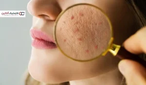 بررسی ارتباط رژیم غذایی و سلامت پوست - آیا مصرف زیاد قند می‌تواند آکنه را تشدید کند؟
